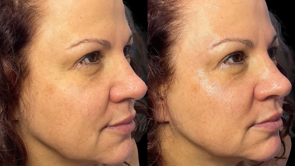 Medical Grade Facials Before & After Gallery - Patient 123129 - Image 3