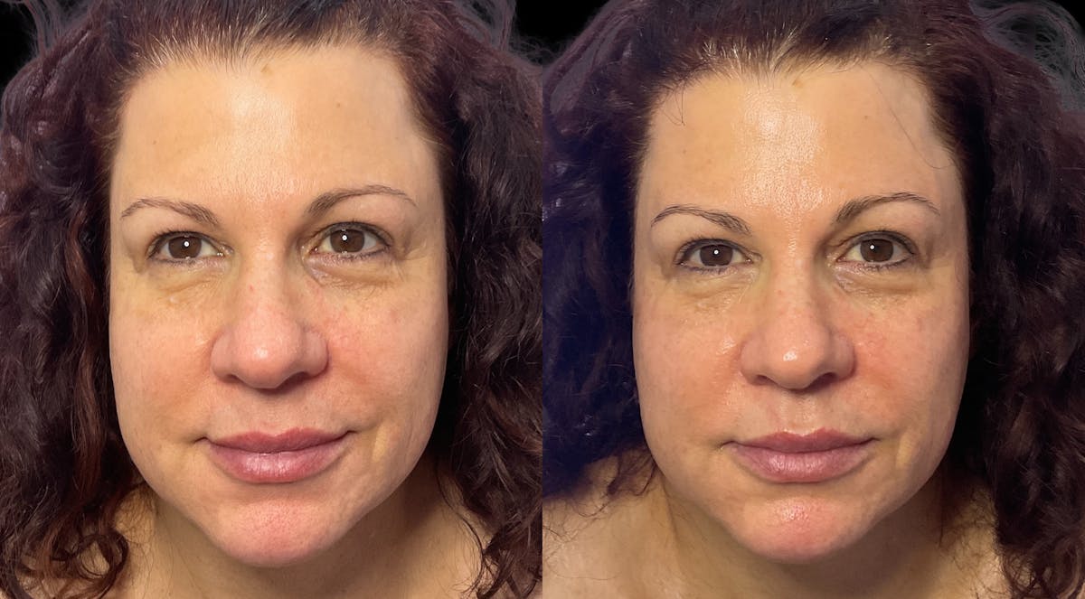 Medical Grade Facials Before & After Gallery - Patient 123129 - Image 1