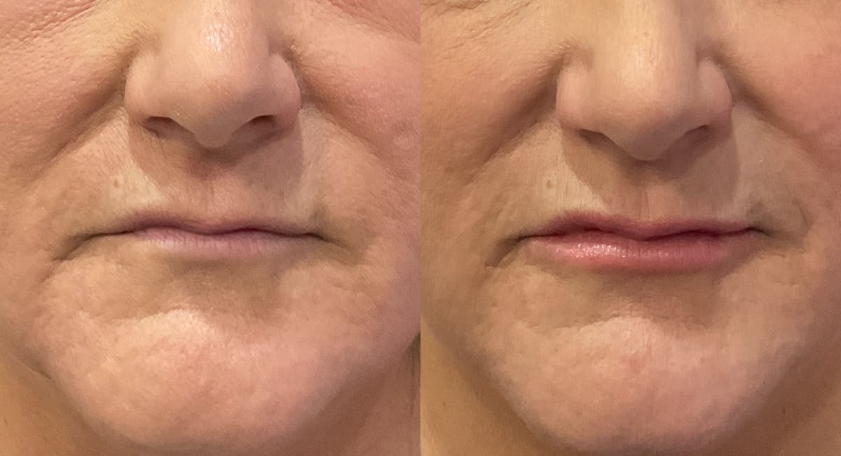 Lip Filler Before & After Gallery - Patient 998435 - Image 1