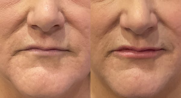 Lip Filler Before & After Gallery - Patient 998435 - Image 1