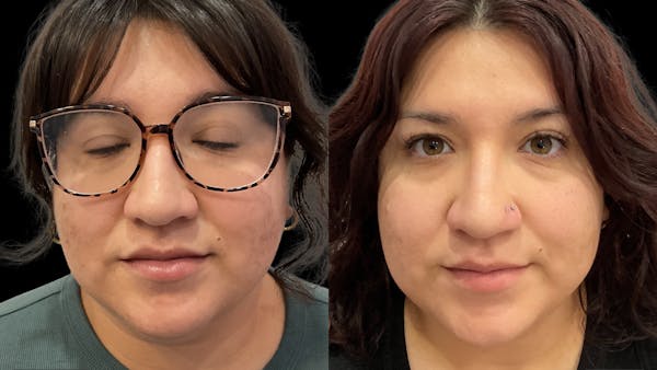 Medical Grade Facials Before & After Gallery - Patient 192662 - Image 1