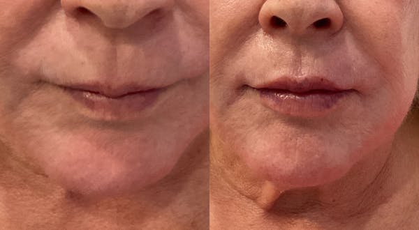 Lip Filler Before & After Gallery - Patient 366047 - Image 1