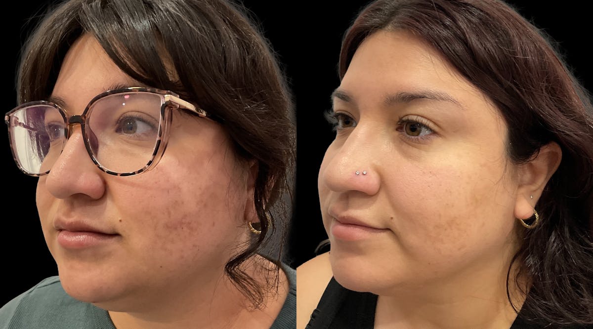 Medical Grade Facials Before & After Gallery - Patient 192662 - Image 2