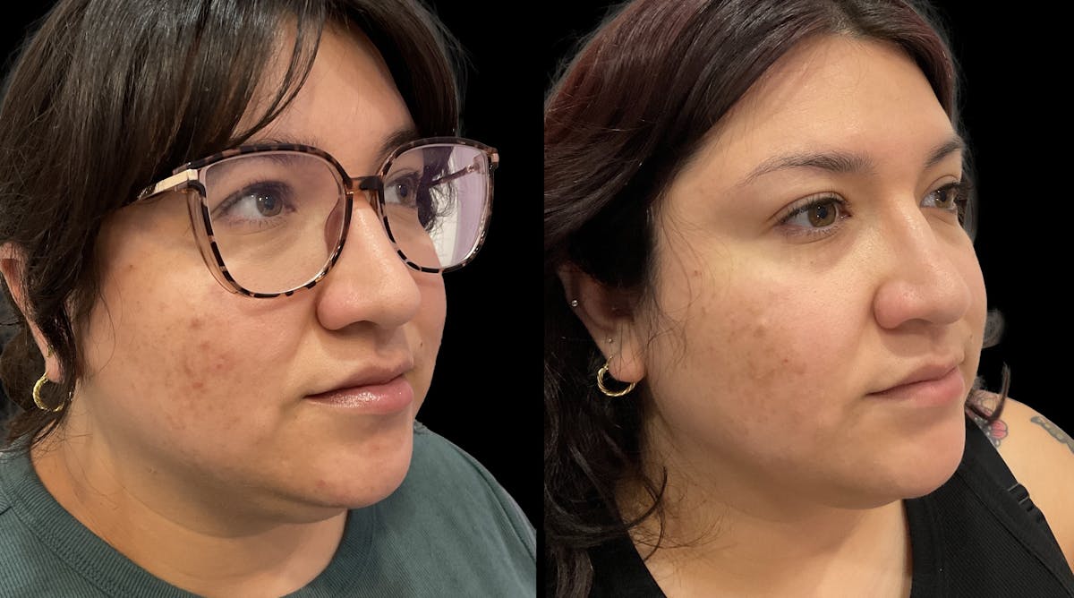 Medical Grade Facials Before & After Gallery - Patient 192662 - Image 3
