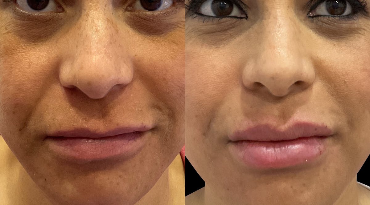 Lip Filler Before & After Gallery - Patient 841101 - Image 1