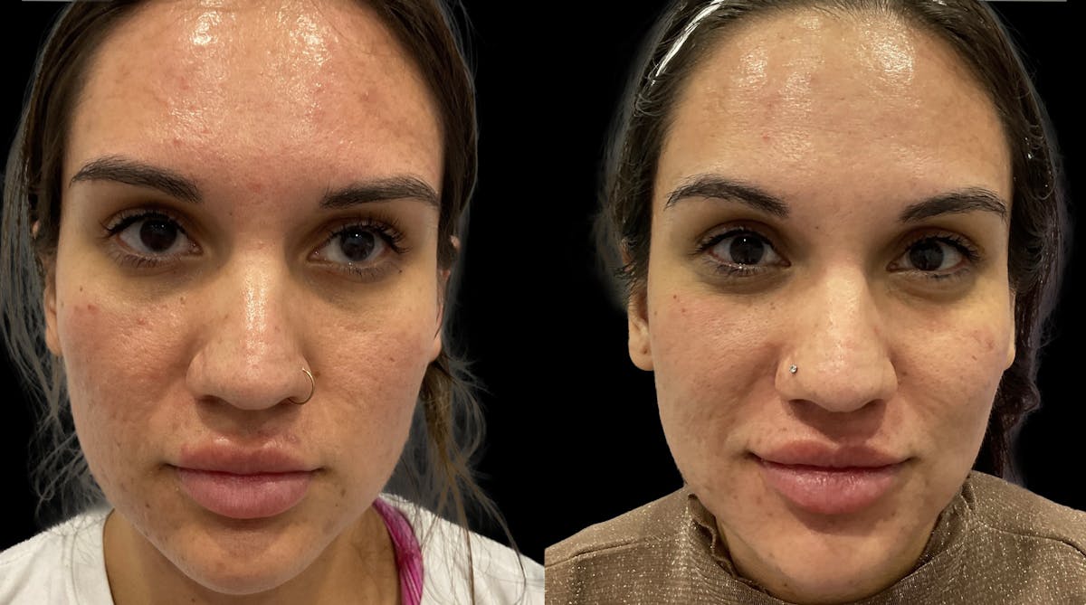 Medical Grade Facials Before & After Gallery - Patient 106412 - Image 1