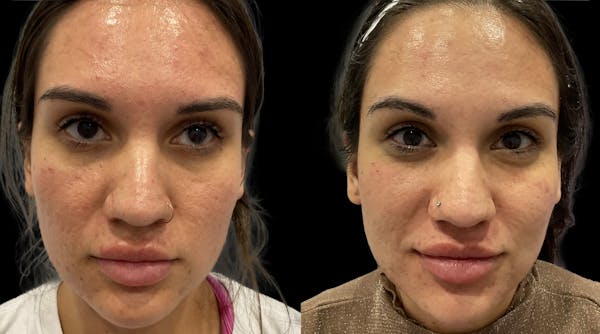 Medical Grade Facials Before & After Gallery - Patient 106412 - Image 1