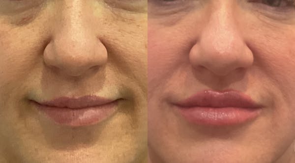 Lip Filler Before & After Gallery - Patient 298188 - Image 1