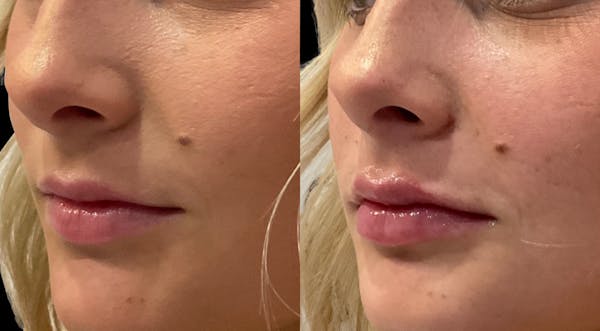 Lip Filler Before & After Gallery - Patient 386755 - Image 1