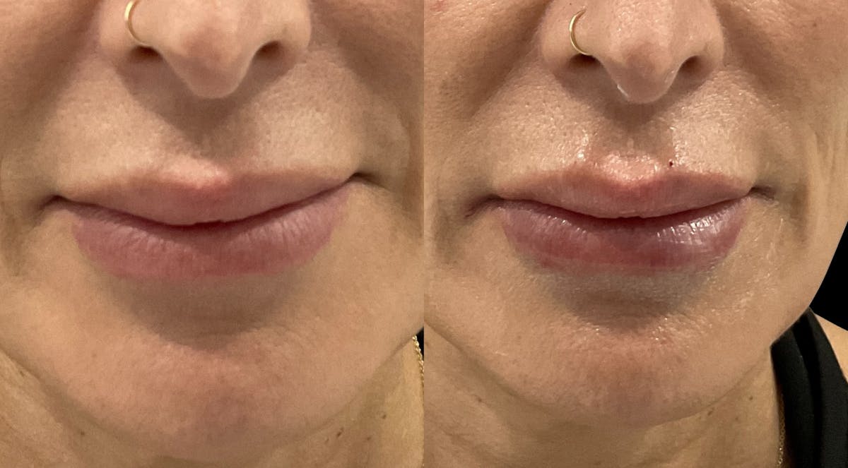 Lip Filler Before & After Gallery - Patient 259158 - Image 1