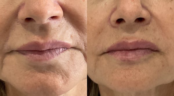 Lip Filler Before & After Gallery - Patient 324842 - Image 1
