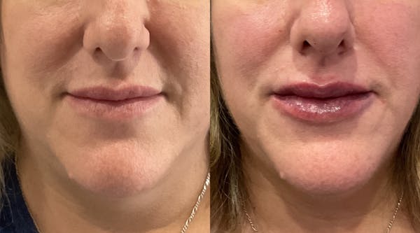 Lip Filler Before & After Gallery - Patient 107615 - Image 1