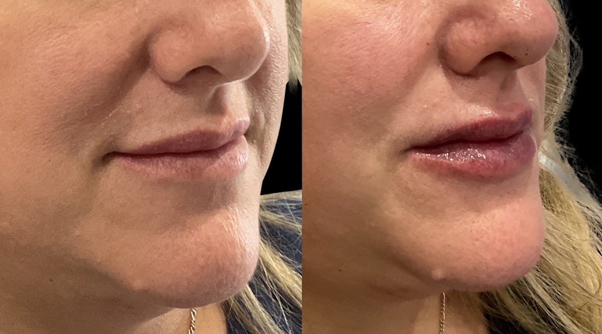 Lip Filler Before & After Gallery - Patient 107615 - Image 2