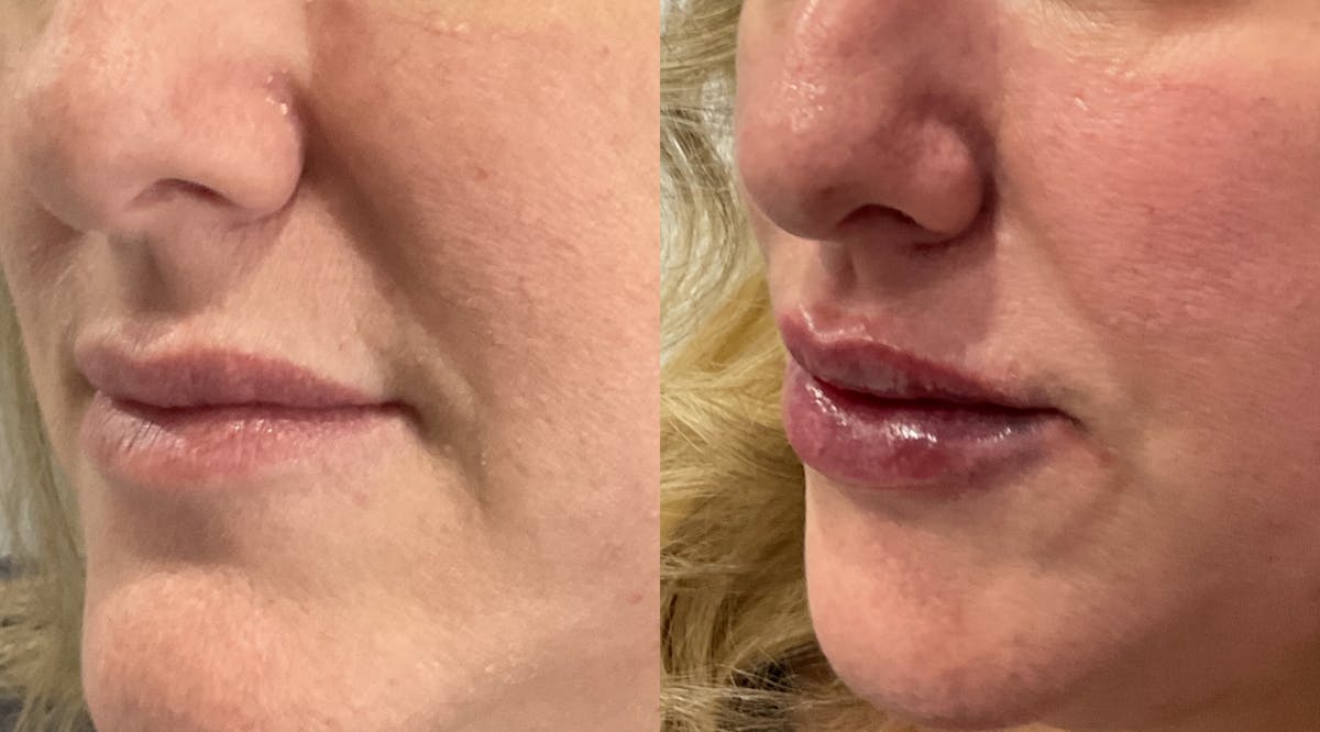 Lip Filler Before & After Gallery - Patient 107615 - Image 3