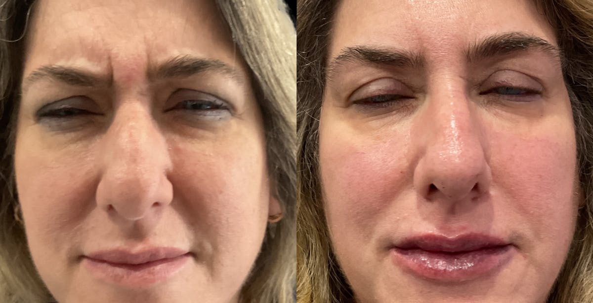 Lip Filler Before & After Gallery - Patient 107615 - Image 4