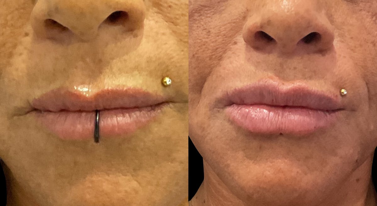 Lip Filler Before & After Gallery - Patient 958828 - Image 1