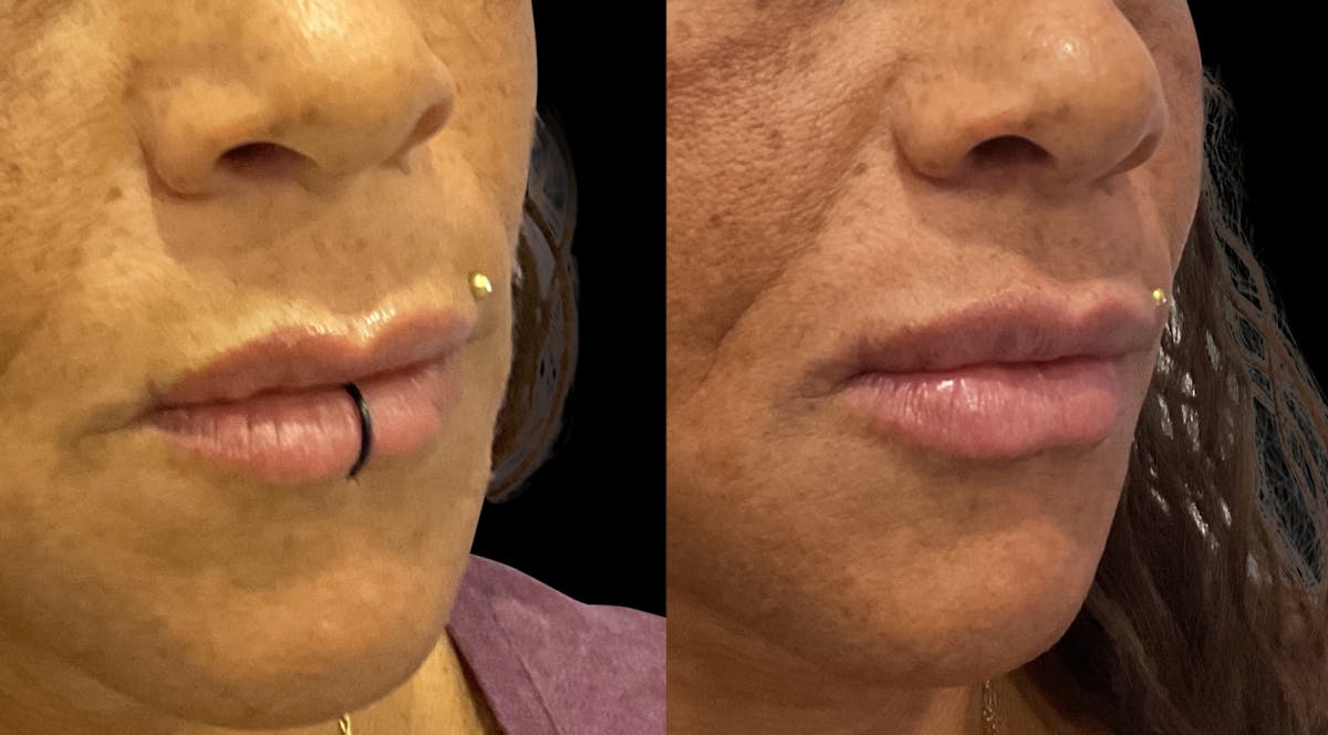 Lip Filler Before & After Gallery - Patient 958828 - Image 2