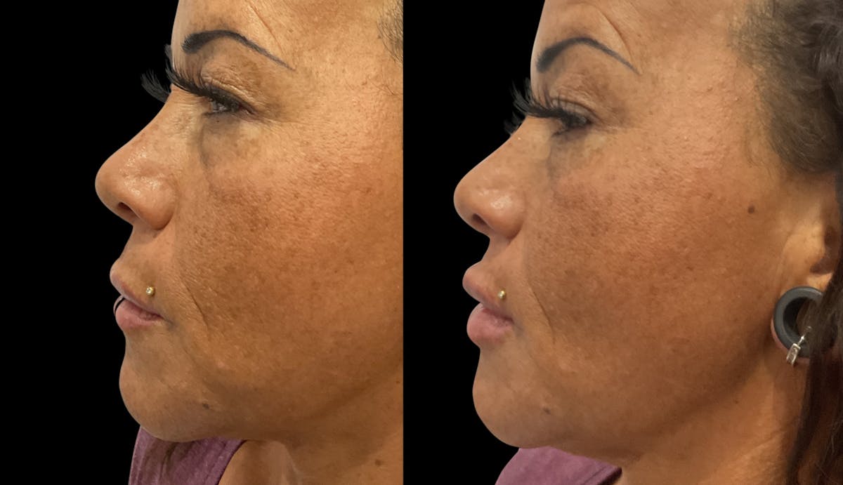 Lip Filler Before & After Gallery - Patient 958828 - Image 3