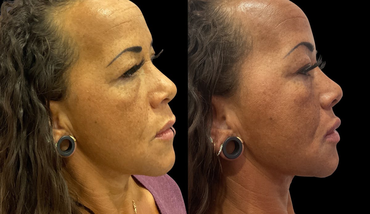 Lip Filler Before & After Gallery - Patient 958828 - Image 4