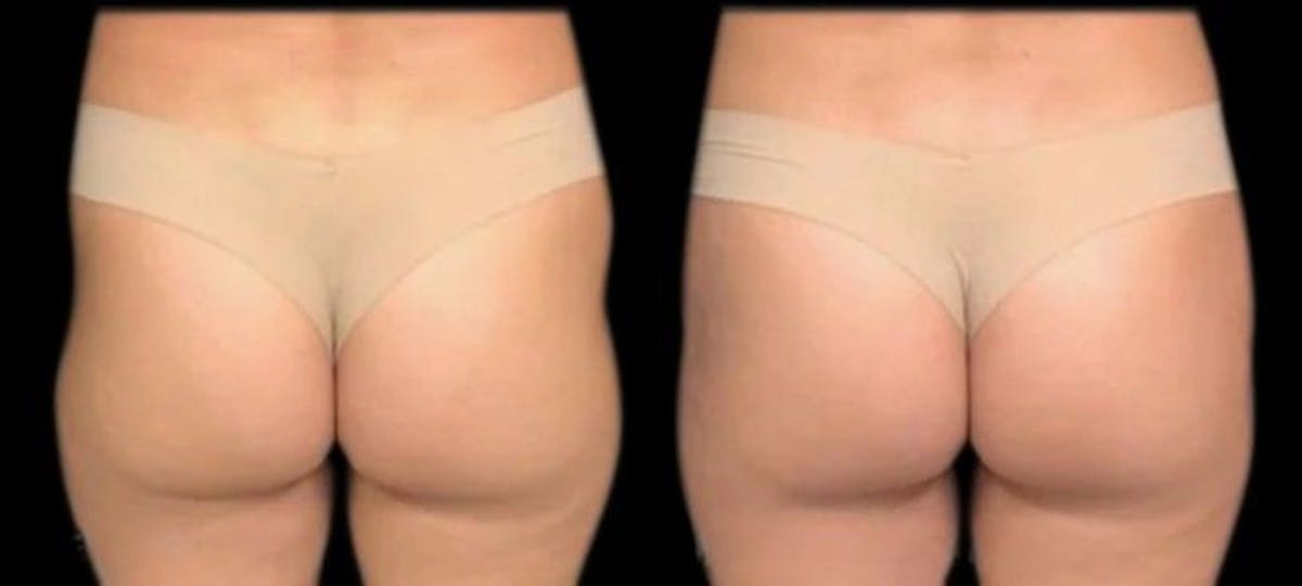 Renuva® Before & After Gallery - Patient 341849 - Image 1