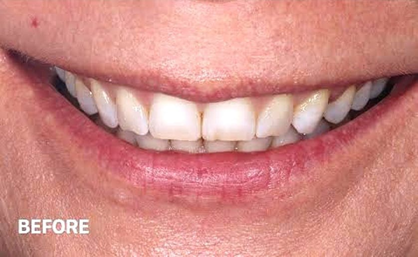Super White Smile Makeover Patient