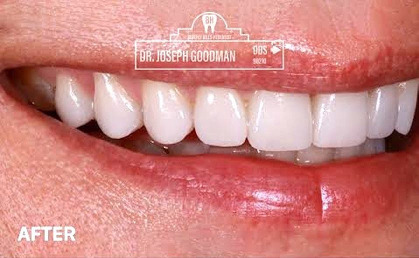 Super White Smile Makeover Patient