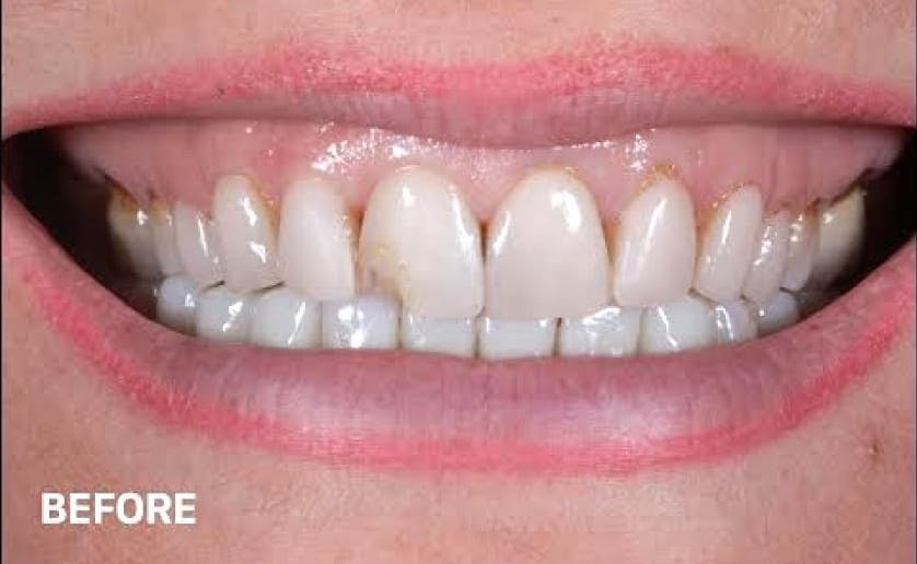 Super White Smile Makeover Patient