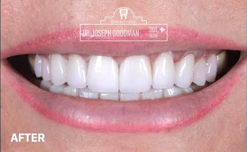 Super White Smile Makeover Patient