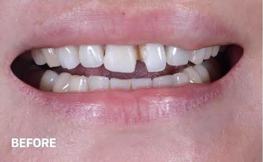 Super White Smile Makeover Patient