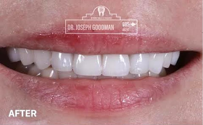 Super White Smile Makeover Patient