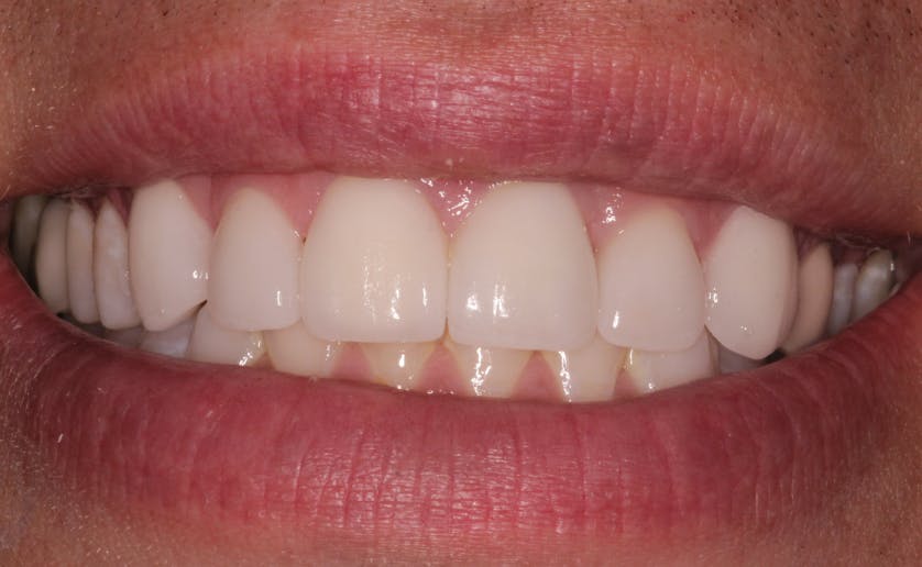 Super White Smile Makeover Patient