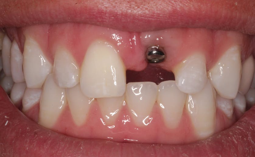 Super White Smile Makeover Patient