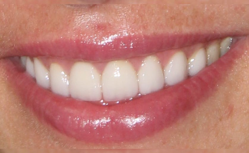 Super White Smile Makeover Patient