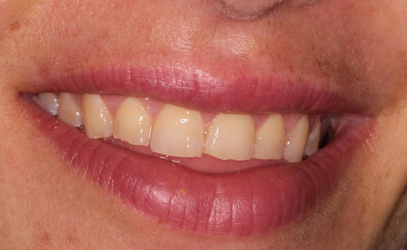 Super White Smile Makeover Patient