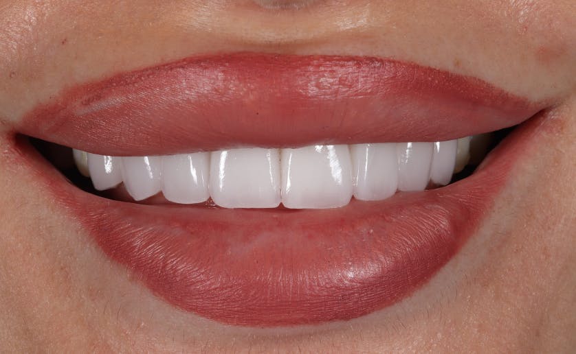 Super White Smile Makeover Patient