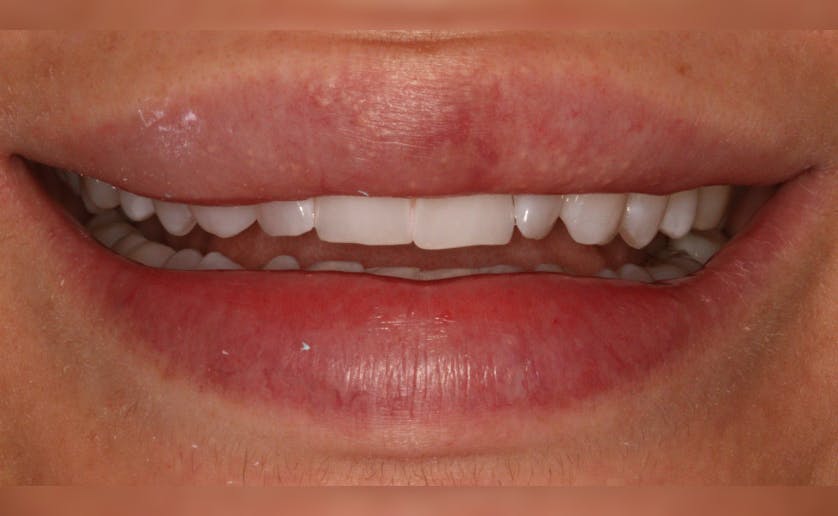 Super White Smile Makeover Patient