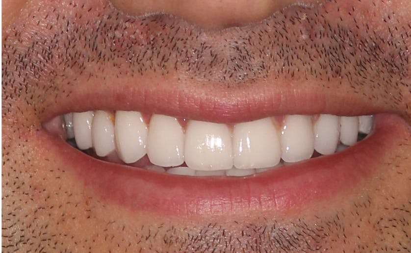 Super White Smile Makeover Patient