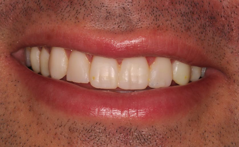 Super White Smile Makeover Patient