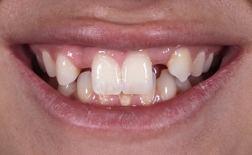 Super White Smile Makeover Patient