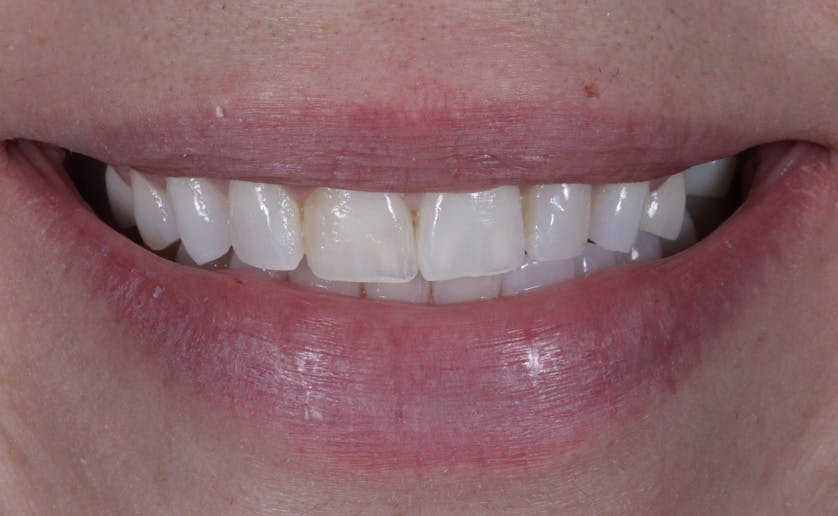 Super White Smile Makeover Patient