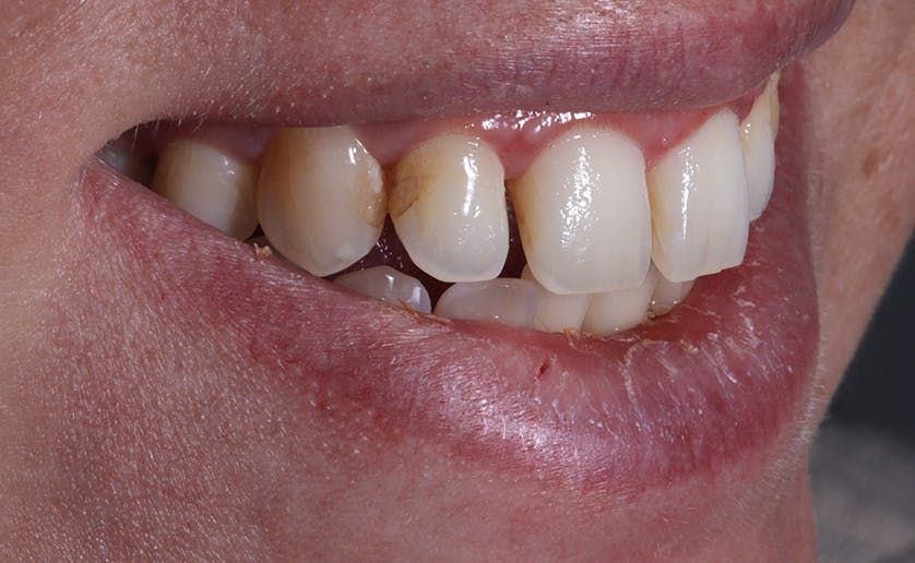 Super White Smile Makeover Patient