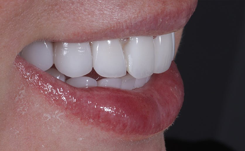Super White Smile Makeover Patient