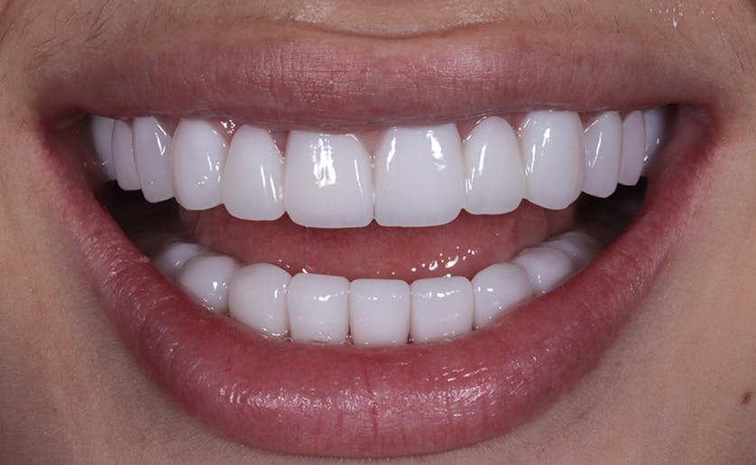 Super White Smile Makeover Patient