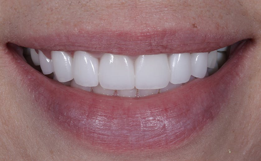Super White Smile Makeover Patient