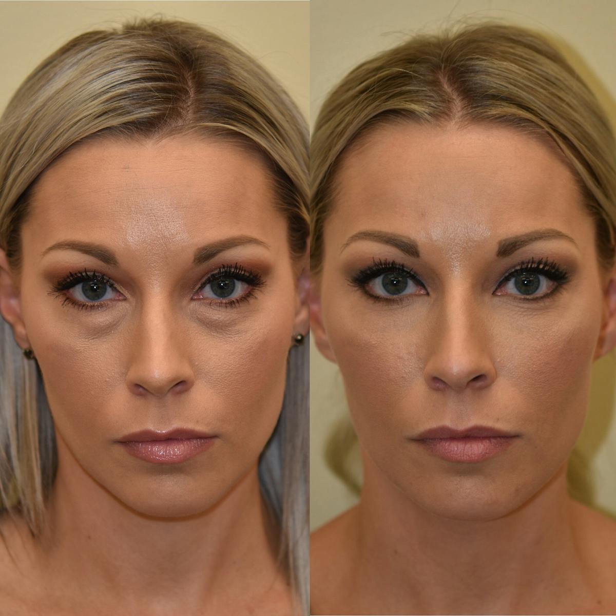 Cheek Filler Before & After Gallery - Patient 156465 - Image 1