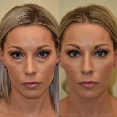Eyelid Surgery Before & After Gallery - Patient 457180 - Image 1