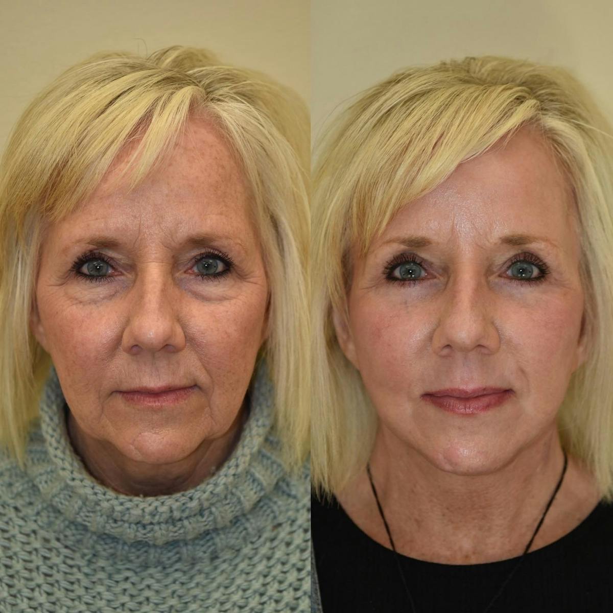 Eyelid Surgery Before & After Gallery - Patient 241926 - Image 2
