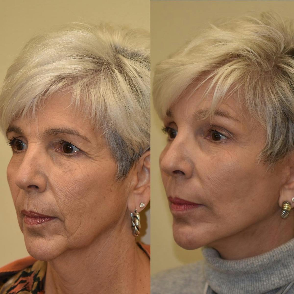 Facelift Before & After Gallery - Patient 937925 - Image 1