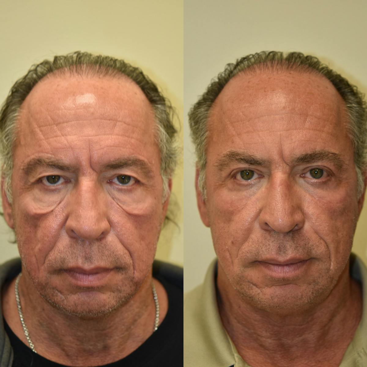 Laser Resurfacing Before & After Gallery - Patient 323788 - Image 1