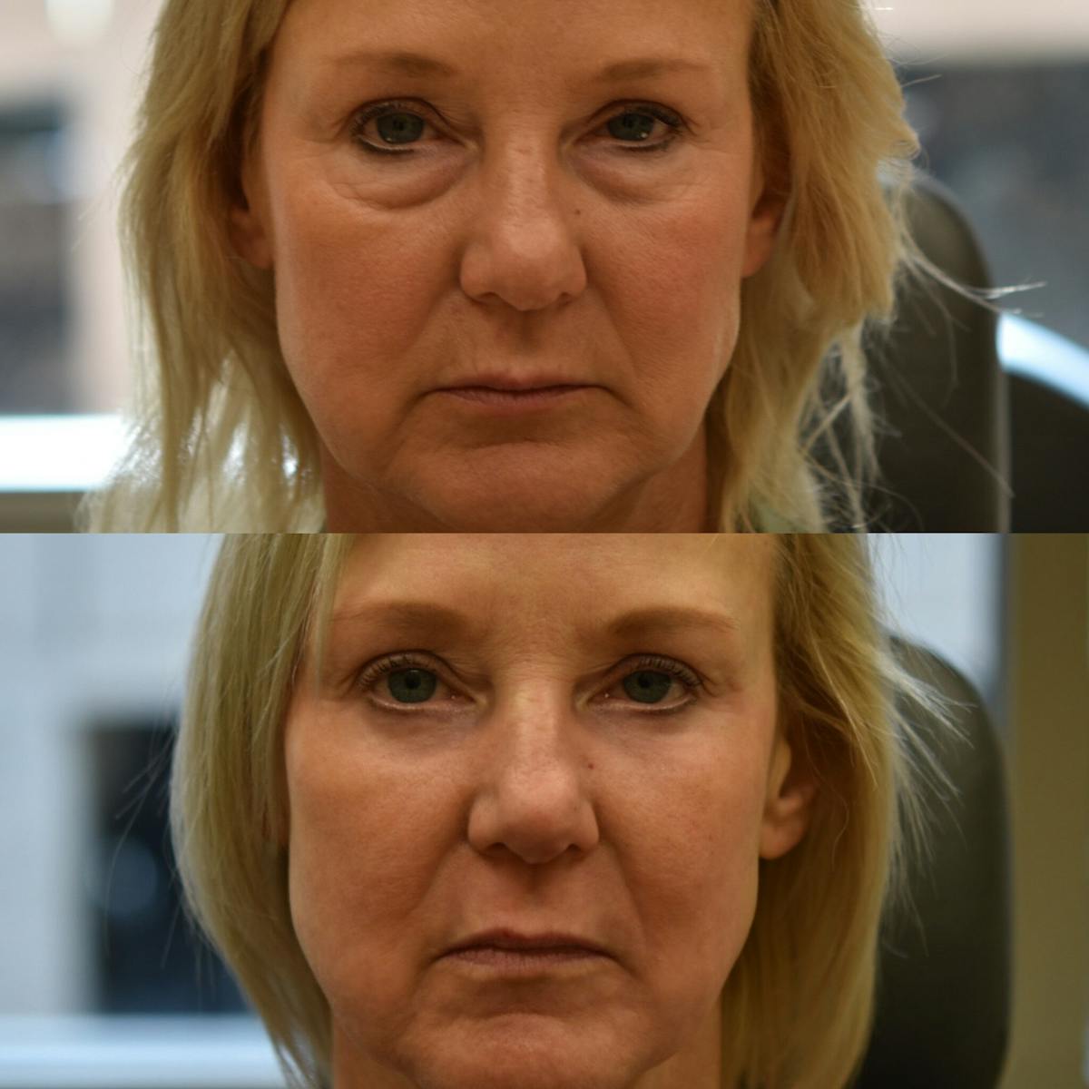 Eyelid Surgery Before & After Gallery - Patient 327140 - Image 2